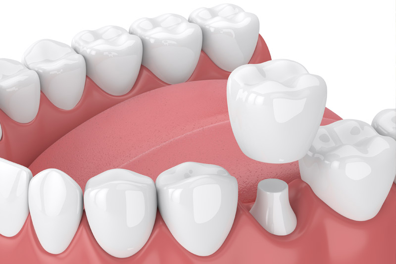 Dental Crowns in  Columbus