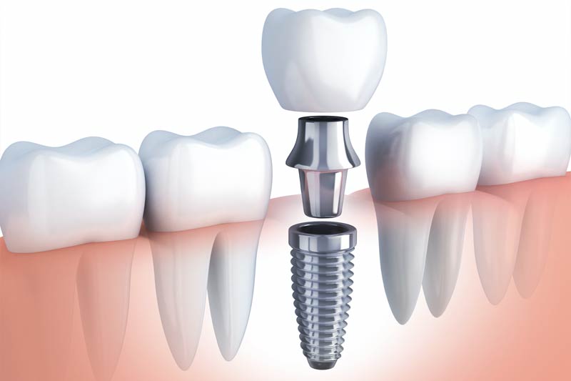 Implants Dentist in  Columbus