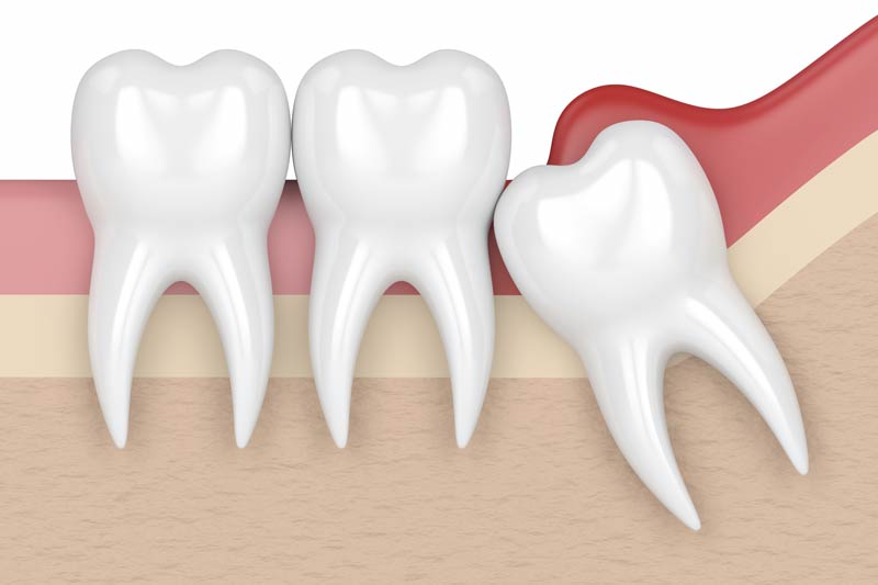 Wisdom Tooth Removal in  Columbus